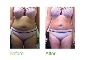before and after Body Wraps | The Face and BOdy Workshop Camberley