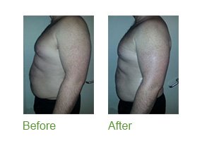 before and after Body Wraps | The Face and BOdy Workshop Camberley